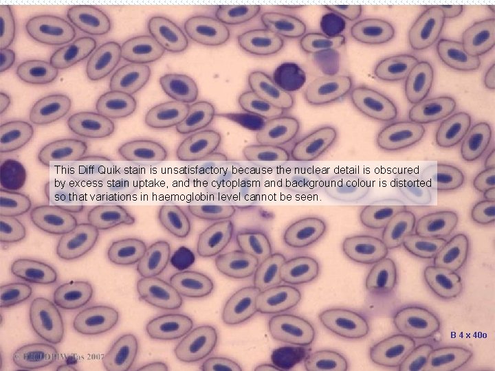 This Diff Quik stain is unsatisfactory because the nuclear detail is obscured by excess