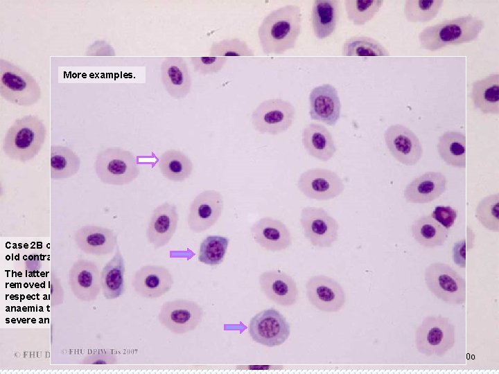 More examples. Case 2 B continued: Yellowtail Kingfish, PCV of 15%, showing detail of