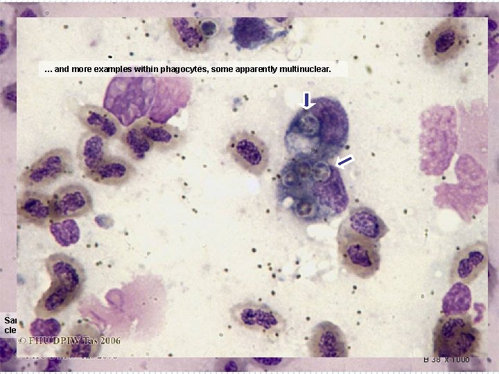 … and more examples within phagocytes, some apparently multinuclear. M M Same Guppy slide: