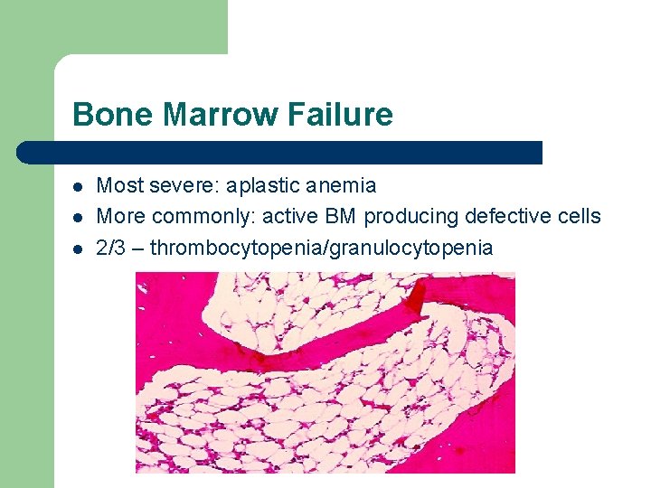 Bone Marrow Failure l l l Most severe: aplastic anemia More commonly: active BM