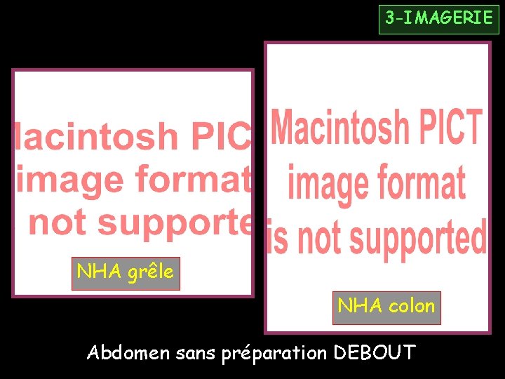 3 -IMAGERIE NHA grêle NHA colon Abdomen sans préparation DEBOUT 