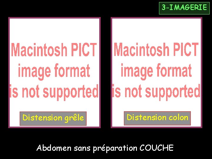 3 -IMAGERIE Distension grêle Distension colon Abdomen sans préparation COUCHE 
