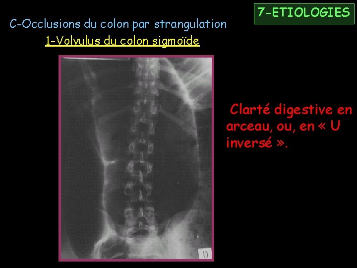 C-Occlusions du colon par strangulation 1 -Volvulus du colon sigmoïde 7 -ETIOLOGIES Clarté digestive