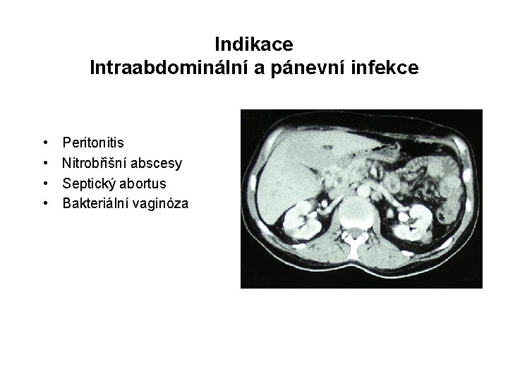 Indikace Intraabdominální a pánevní infekce • • Peritonitis Nitrobřišní abscesy Septický abortus Bakteriální vaginóza