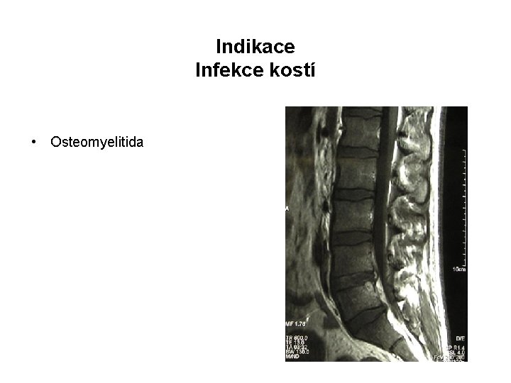Indikace Infekce kostí • Osteomyelitida 