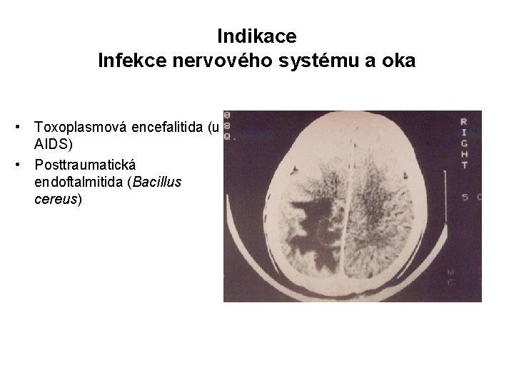 Indikace Infekce nervového systému a oka • Toxoplasmová encefalitida (u AIDS) • Posttraumatická endoftalmitida
