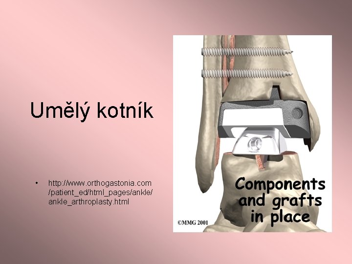 Umělý kotník • http: //www. orthogastonia. com /patient_ed/html_pages/ankle/ ankle_arthroplasty. html 