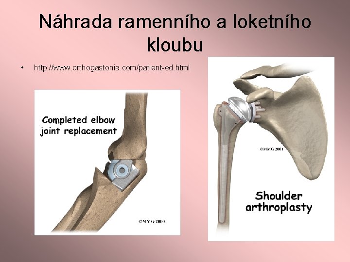 Náhrada ramenního a loketního kloubu • http: //www. orthogastonia. com/patient-ed. html 