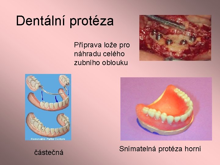 Dentální protéza Příprava lože pro náhradu celého zubního oblouku částečná Snímatelná protéza horní 