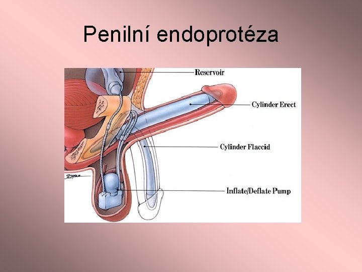 Penilní endoprotéza 