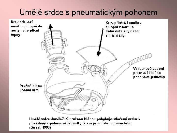 Umělé srdce s pneumatickým pohonem 