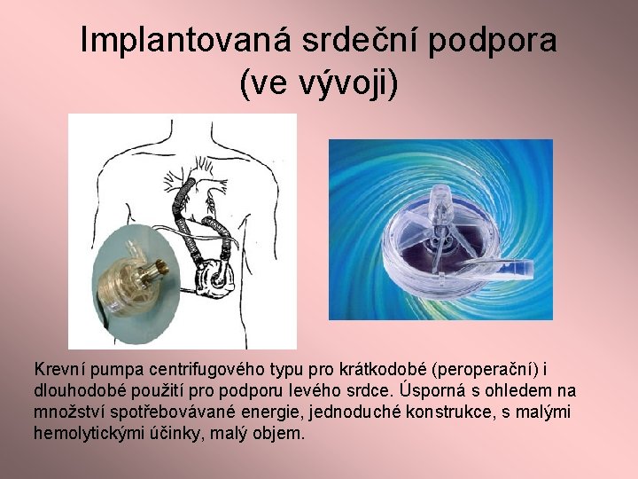 Implantovaná srdeční podpora (ve vývoji) Krevní pumpa centrifugového typu pro krátkodobé (peroperační) i dlouhodobé