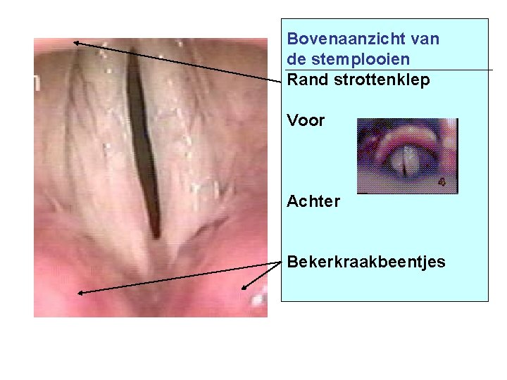 Bovenaanzicht van de stemplooien Rand strottenklep Voor Achter Bekerkraakbeentjes 