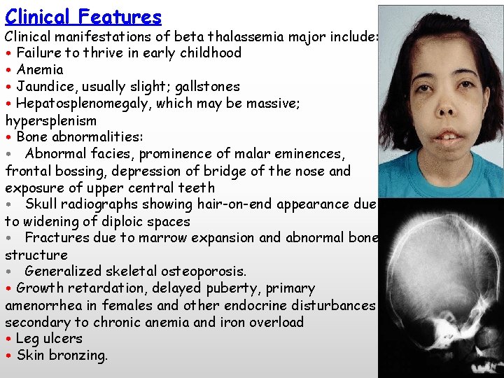 Clinical Features Clinical manifestations of beta thalassemia major include: • Failure to thrive in