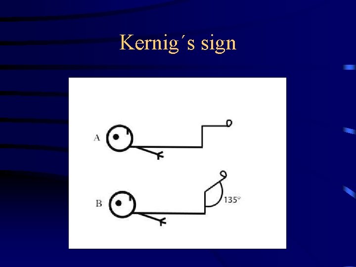 Kernig´s sign 