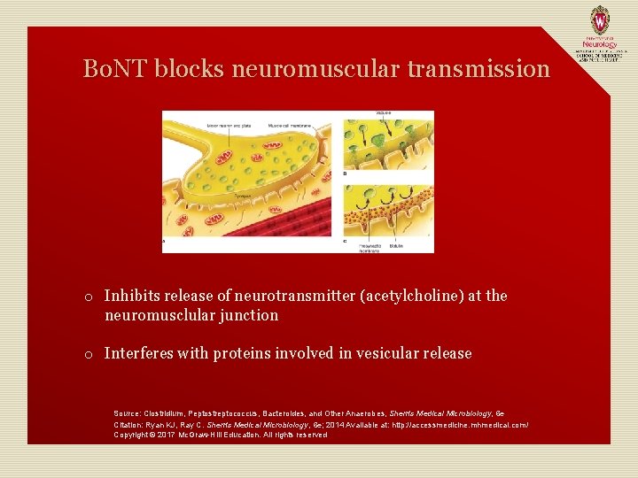 Bo. NT blocks neuromuscular transmission o Inhibits release of neurotransmitter (acetylcholine) at the neuromusclular