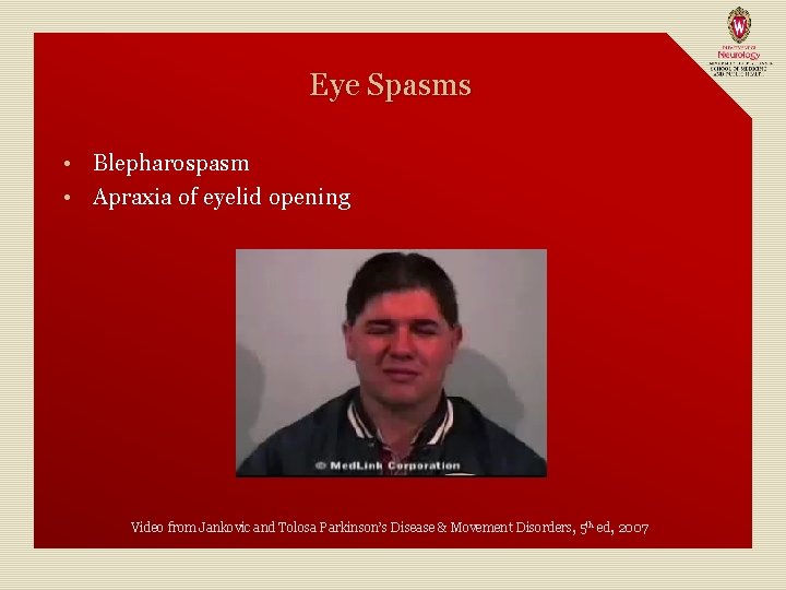 Eye Spasms Blepharospasm • Apraxia of eyelid opening • Video from Jankovic and Tolosa
