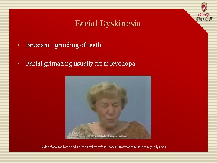 Facial Dyskinesia • Bruxism= grinding of teeth • Facial grimacing usually from levodopa Video