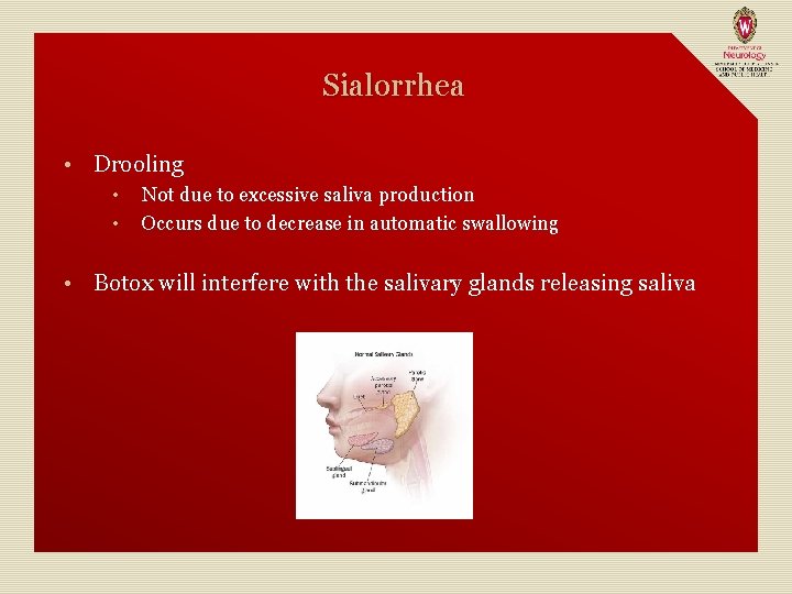 Sialorrhea • Drooling • • • Not due to excessive saliva production Occurs due