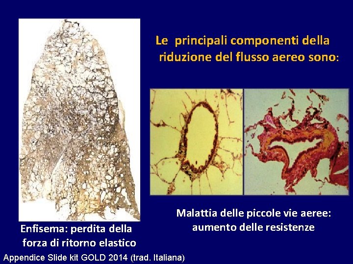 Le principali componenti della riduzione del flusso aereo sono: Enfisema: perdita della forza di