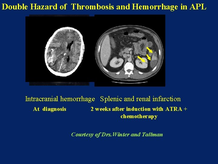 Double Hazard of Thrombosis and Hemorrhage in APL Thrombosis: 12 – 25 % ≈