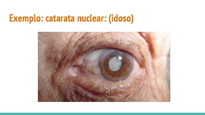 Exemplo: catarata nuclear: (idoso) 