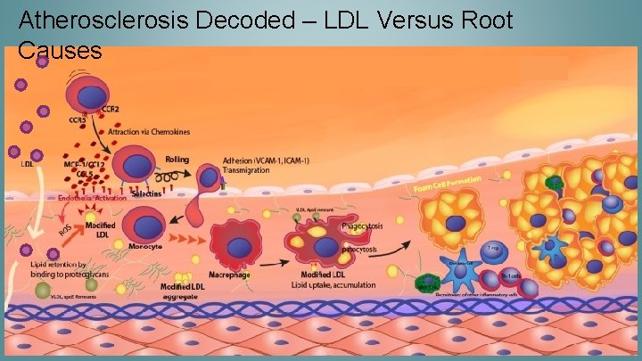 Atherosclerosis Decoded – LDL Versus Root Causes 