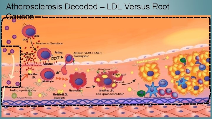 Atherosclerosis Decoded – LDL Versus Root Causes 