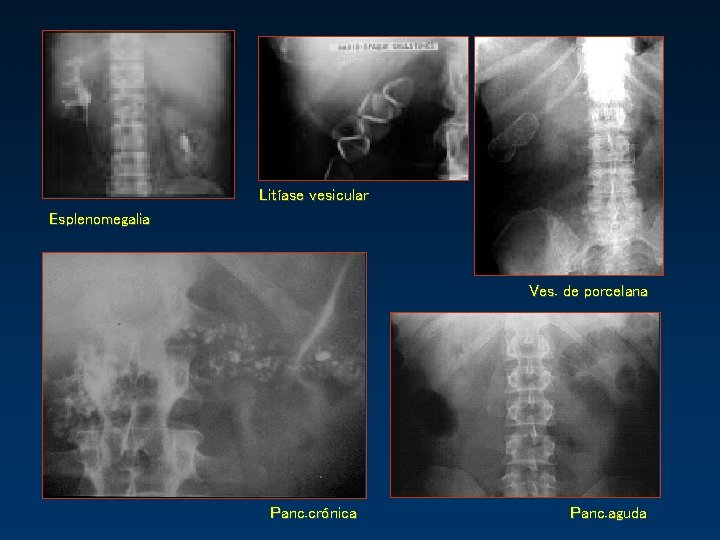 Litíase vesicular Esplenomegalia Ves. de porcelana Panc. crónica Panc. aguda 