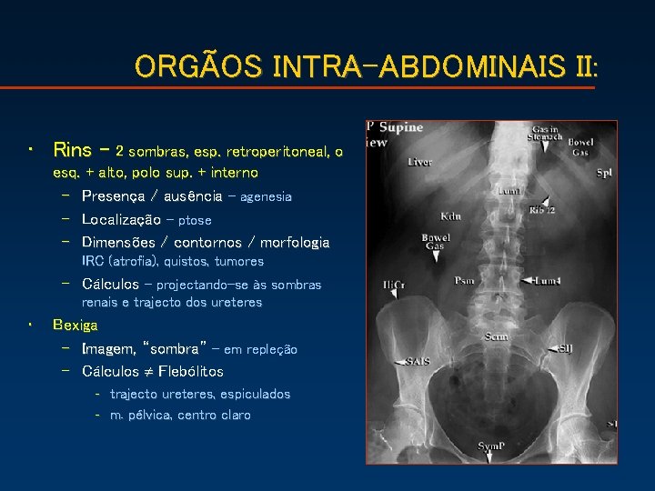 ORGÃOS INTRA-ABDOMINAIS II: • Rins – 2 sombras, esp. retroperitoneal, o esq. + alto,