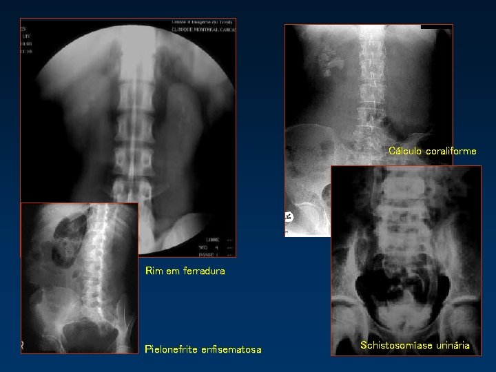 Cálculo coraliforme Rim em ferradura Pielonefrite enfisematosa Schistosomíase urinária 