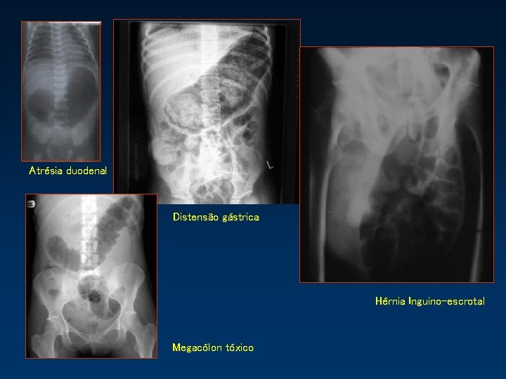 Atrésia duodenal Distensão gástrica Hérnia Inguino-escrotal Megacólon tóxico 