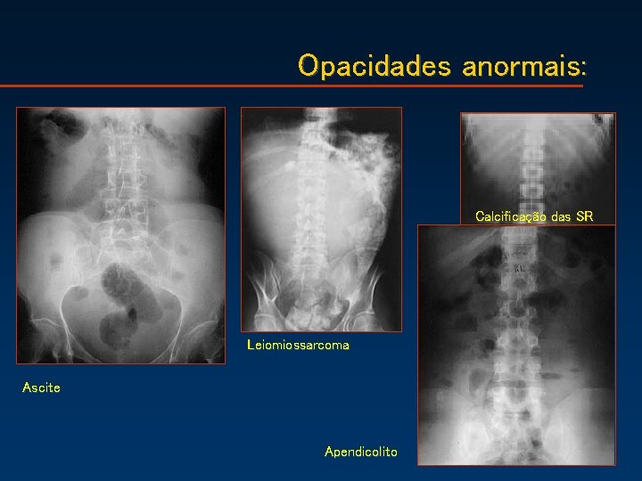 Opacidades anormais: Calcificação das SR Leiomiossarcoma Ascite Apendicolito 