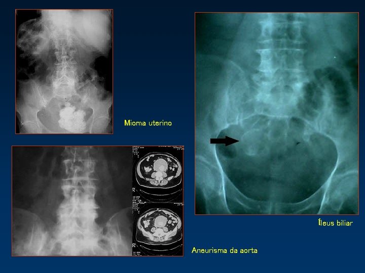 Mioma uterino Íleus biliar Aneurisma da aorta 