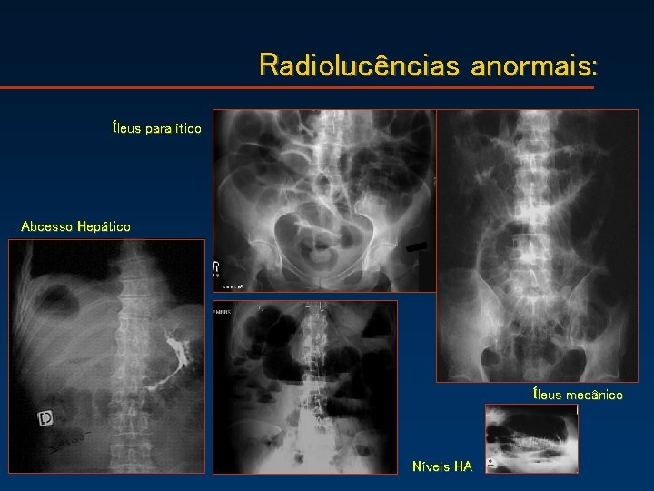 Radiolucências anormais: Íleus paralítico Abcesso Hepático Íleus mecânico Níveis HA 