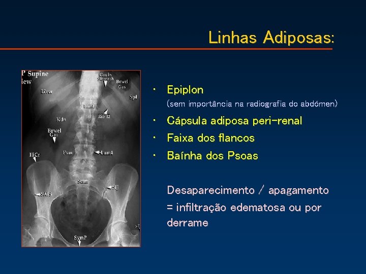 Linhas Adiposas: • Epiplon (sem importância na radiografia do abdómen) • • • Cápsula