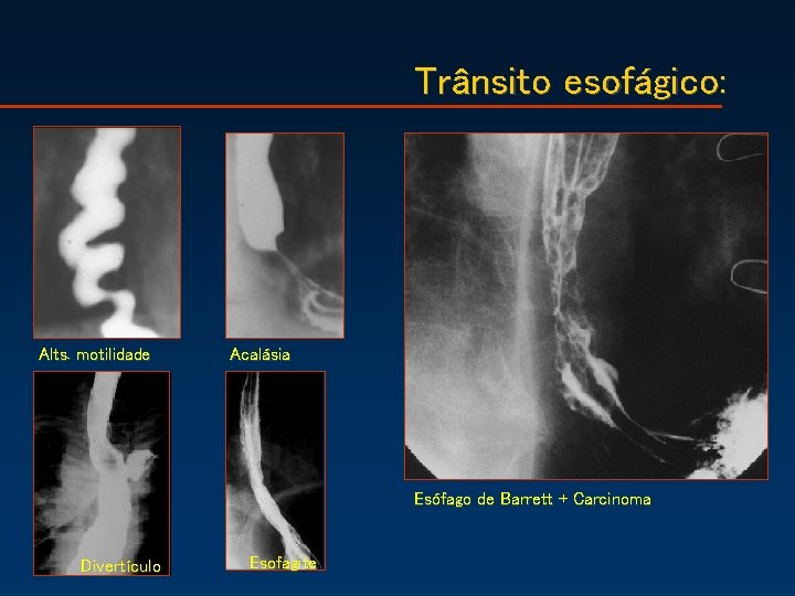 Trânsito esofágico: Alts. motilidade Acalásia Esófago de Barrett + Carcinoma Divertículo Esofagite 