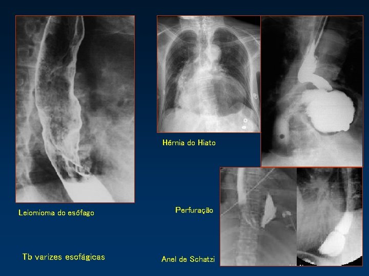 Hérnia do Hiato Leiomioma do esófago Tb varizes esofágicas Perfuração Anel de Schatzi 