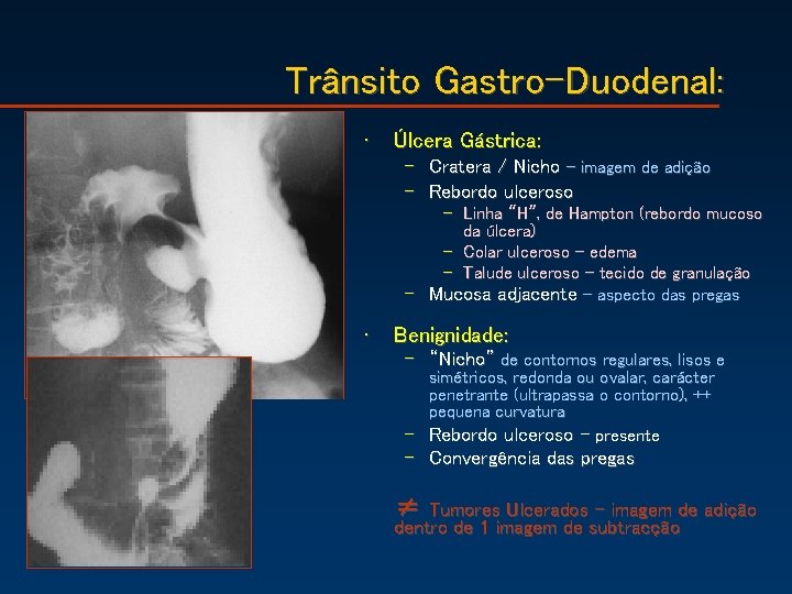 Trânsito Gastro-Duodenal: • Úlcera Gástrica: – Cratera / Nicho – imagem de adição –