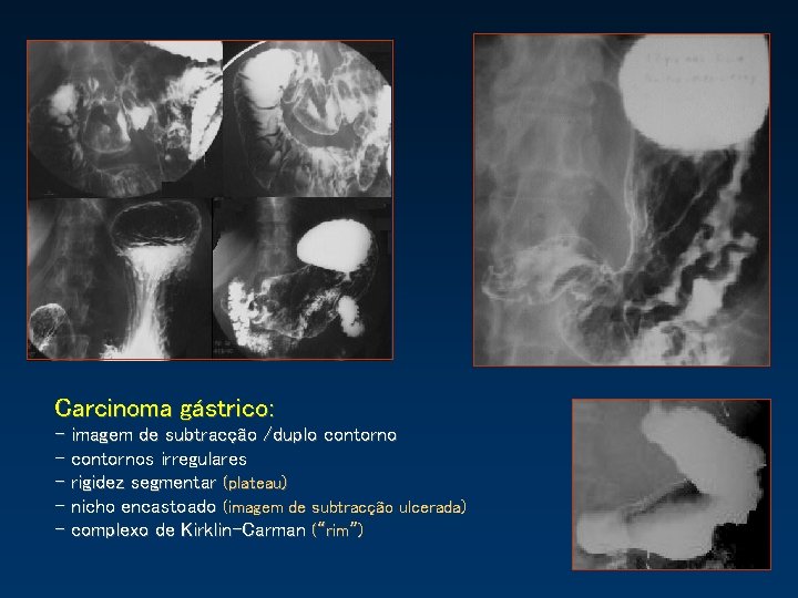 Carcinoma gástrico: - imagem de subtracção /duplo contorno - contornos irregulares - rigidez segmentar