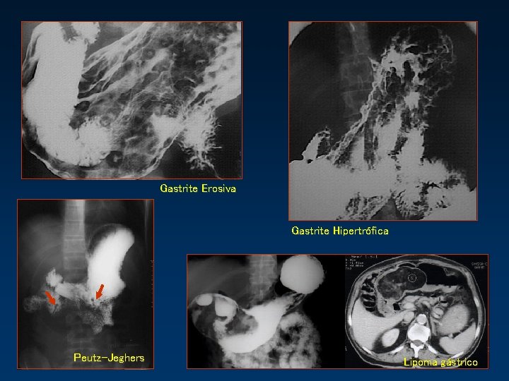 Gastrite Erosiva Gastrite Hipertrófica Peutz-Jeghers Lipoma gástrico 