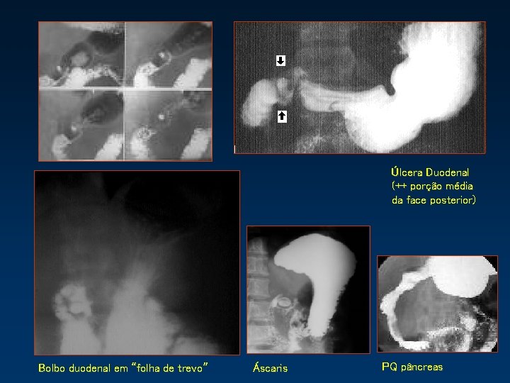 Úlcera Duodenal (++ porção média da face posterior) Bolbo duodenal em “folha de trevo”