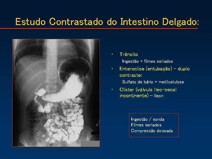 Estudo Contrastado do Intestino Delgado: • Trânsito Ingestão + filmes seriados • Enteroclise (entubação)