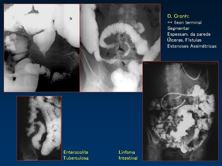 D. Cronh: ++ íleon terminal Segmentar Espessam. da parede Úlceras, Fístulas Estenoses Assimétricas Enterocolite