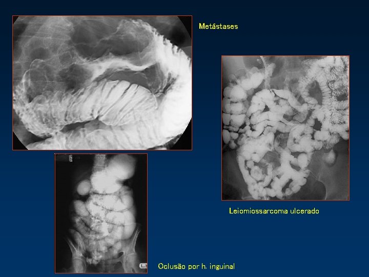 Metástases Leiomiossarcoma ulcerado Oclusão por h. inguinal 