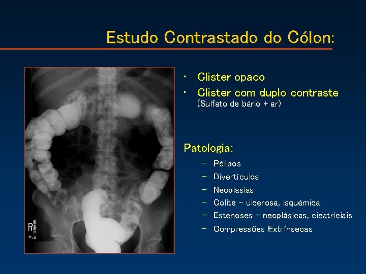 Estudo Contrastado do Cólon: • Clister opaco • Clister com duplo contraste (Sulfato de