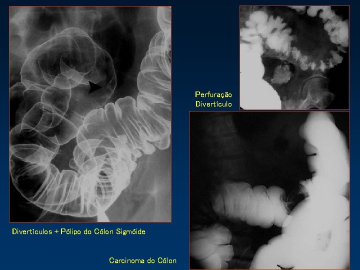 Perfuração Divertículos + Pólipo do Cólon Sigmóide Carcinoma do Cólon 