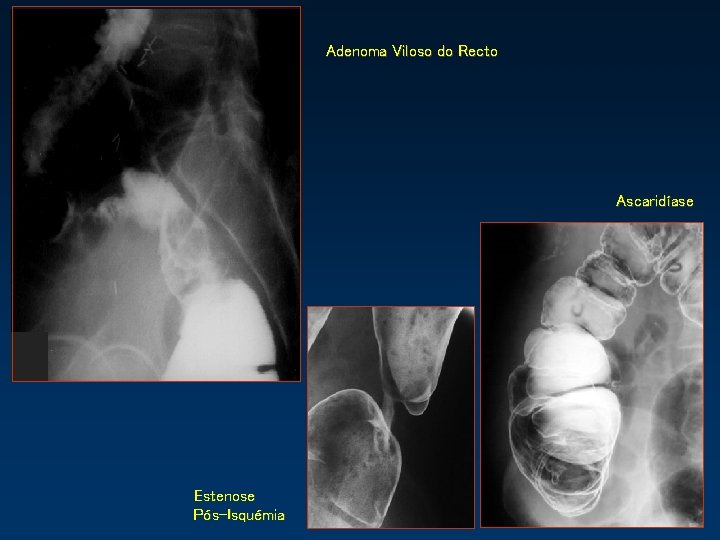 Adenoma Viloso do Recto Ascaridíase Estenose Pós-Isquémia 