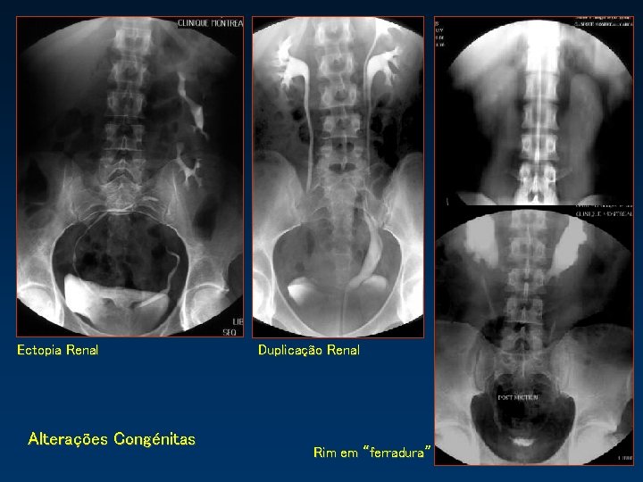 Ectopia Renal Alterações Congénitas Duplicação Renal Rim em “ferradura” 