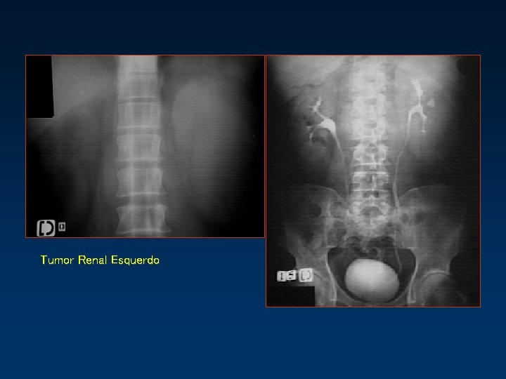 Tumor Renal Esquerdo 